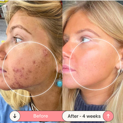 Acne-Proof Pillow + Pillowcase