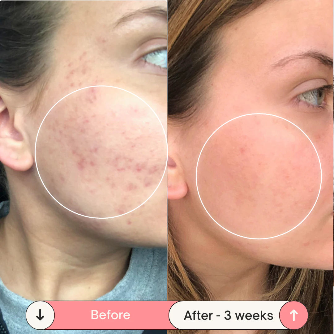 Acne-Proof Pillow + Pillowcase