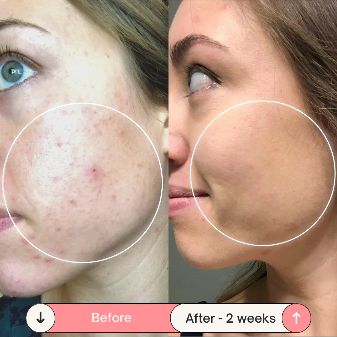 Acne-Proof Pillow + Pillowcase